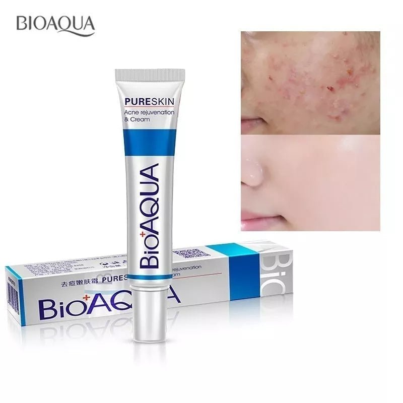 Bioaqua 30g Acne Treatment Blackhead Removal Cream - Neozen Store