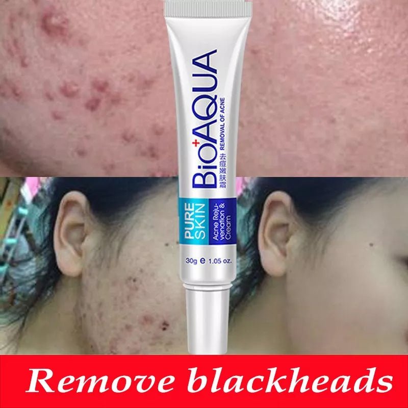 Bioaqua 30g Acne Treatment Blackhead Removal Cream - Neozen Store